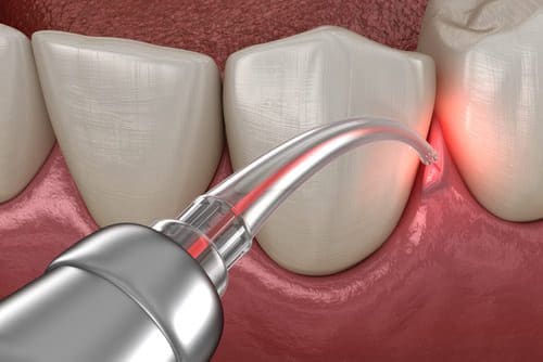Comfortable and safe dental treatment with laser devices in Oakville ON